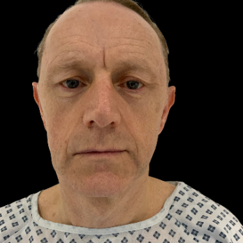 male-facelift-before